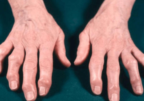 Artrosis manos