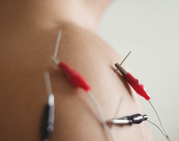 Neuromodulación Funcional Percutánea