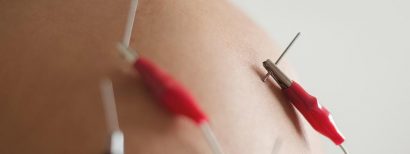 Neuromodulación Funcional Percutánea