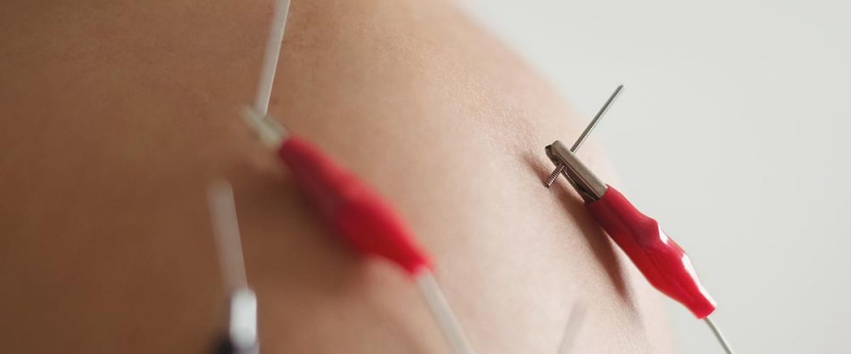 Neuromodulación Funcional Percutánea