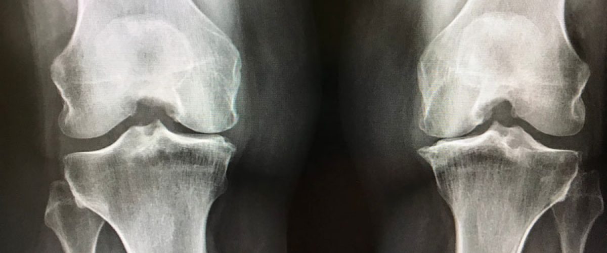 xray-shows-narrowing-of-bones-at-the-knees-cartil-2022-03-16-23-29-50-utc